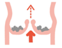 狭窄症の弁が開いている時のイメージ